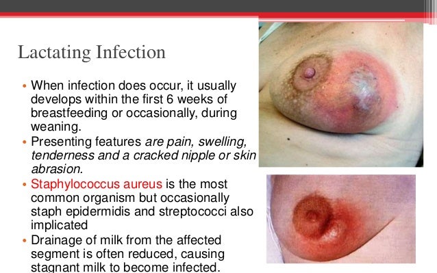 breast mastitis abscess Breast mastitis abscess